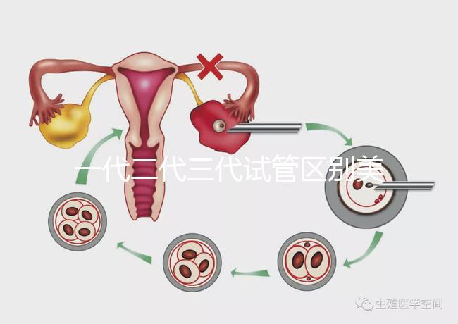 一代二代三代試管區別美琳達（一代二代三代試管區別及價格）