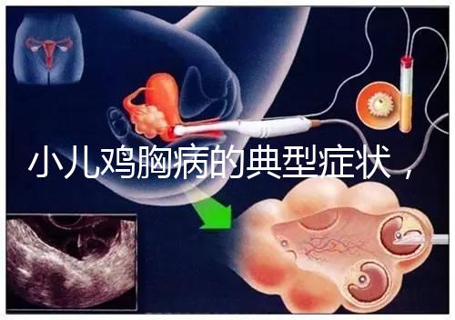 小兒雞胸病的典型癥狀，早發現早治療很重要！