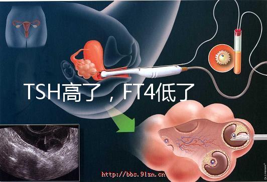 TSH高了，FT4低了，需要補碘嗎？